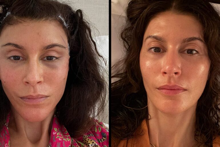 What It's Really Like to Get a Facelift at 48