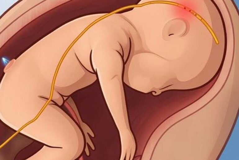Tiny probe monitors unborn baby’s health inside womb during surgery