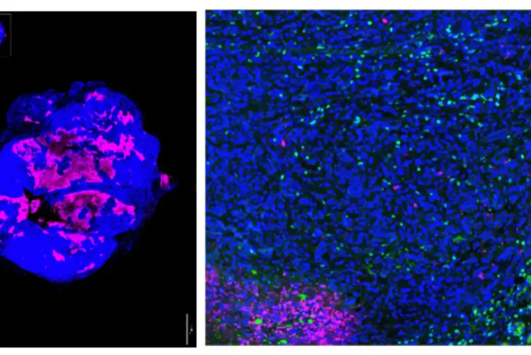Now immune cells can see pancreatic tumors—and attack them – lji.org