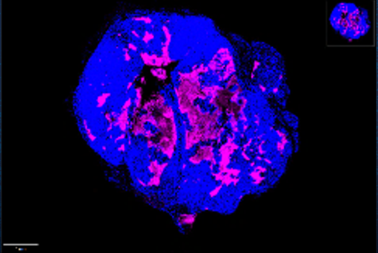 Immunity Against Common Virus Leveraged Against Pancreatic Cancer