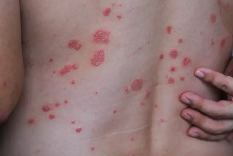 Newly Found Immune Cells Link Strep Throat To Psoriasis