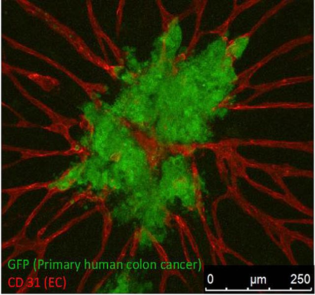 Magnification of a human colon tumor growing in a network of blood vessels on a tissue chip. A few green tumor cells are leaving the main tumor and flowing out through the blood vessels. [National Center for Advancing Translational Sciences, Bethesda, MD/Wiki Commons]