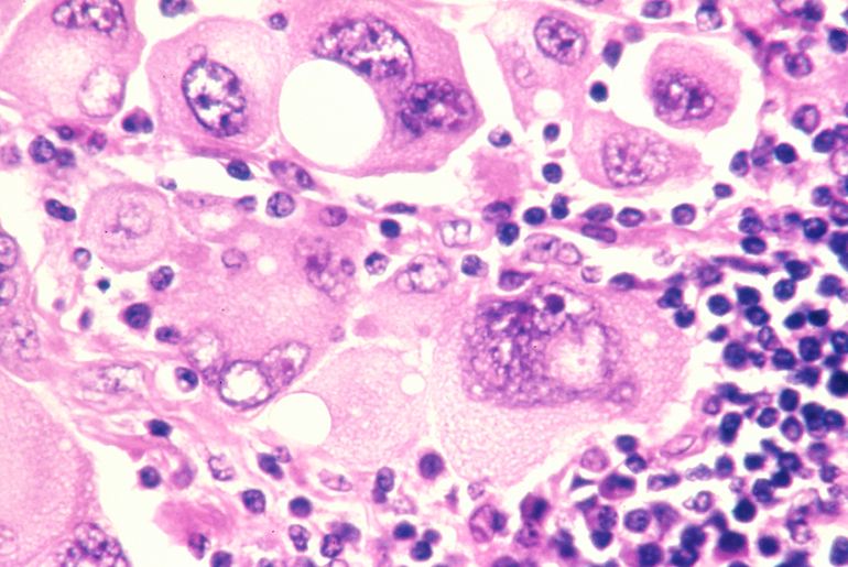 HOXD13 drives angiogenesis and immune evasion in melanoma