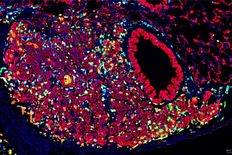 Cancer Stress Protein Helps Tumors Hide from Immunity