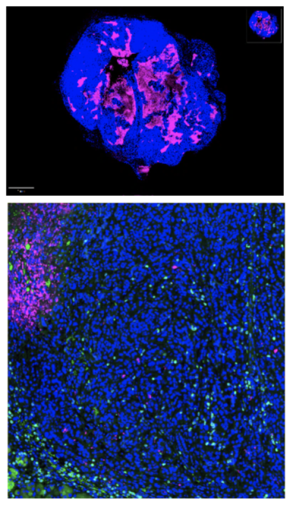Microscopt image with florescent cells. Tumor tissue is blue. There is a smattering of neon pink and some dots of green.