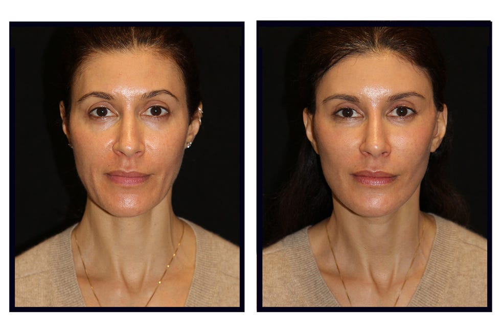 before and after facelift photos at 48