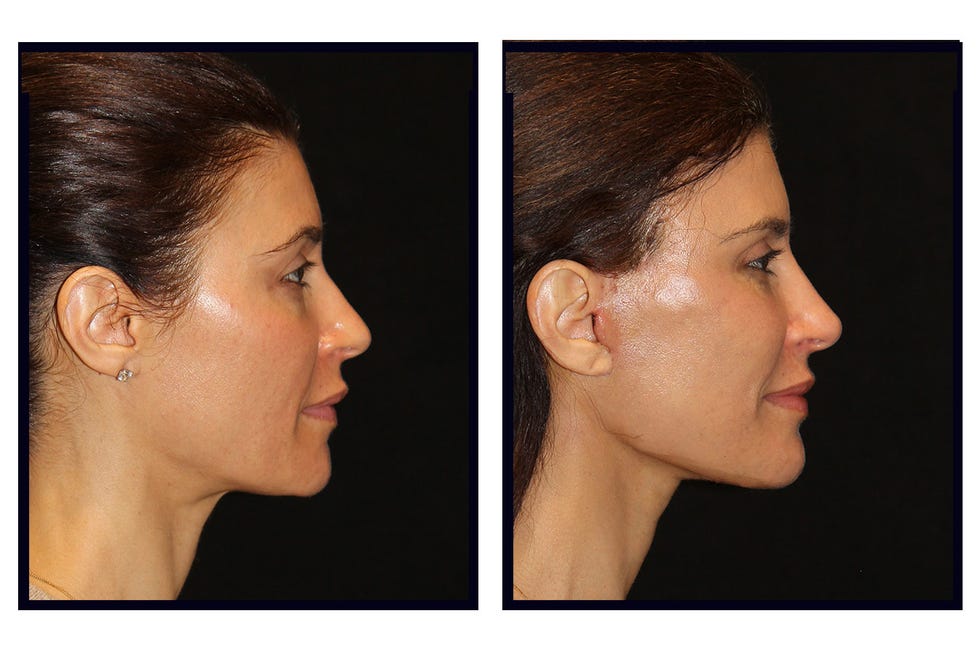 before and after comparison of a facial profile