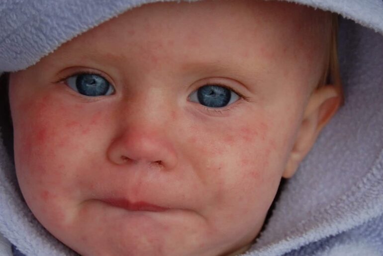 baby with measles