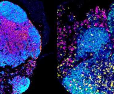 Ovarian cancer image