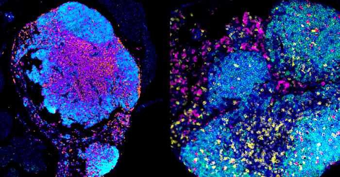 Ovarian cancer image