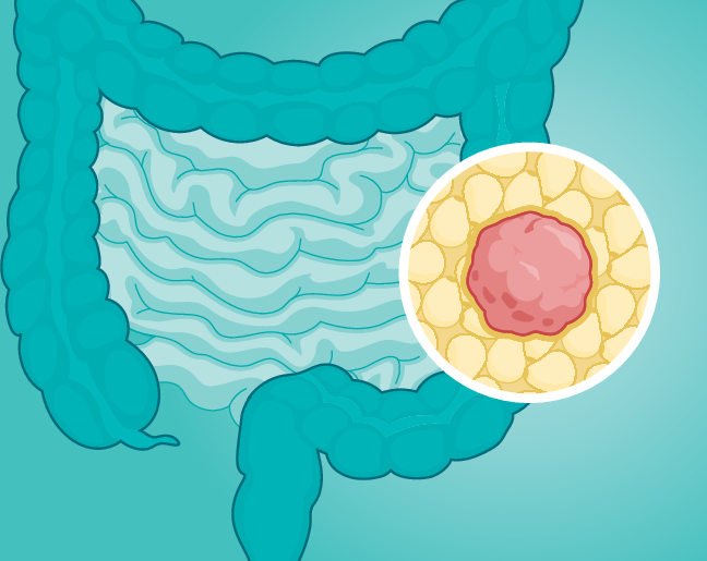 Peritumoural adipose tissue protects colorectal cancer from immune attack