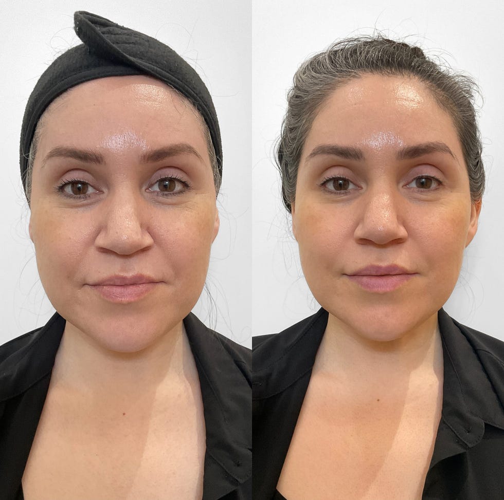 Before and After XERF treatment