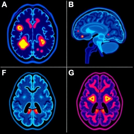Brain Metastases in Renal Cancer: Immune Insights