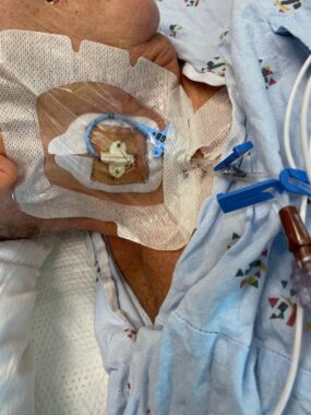 A closeup of an IV inserted into a woman's jugular vein on her neck. 