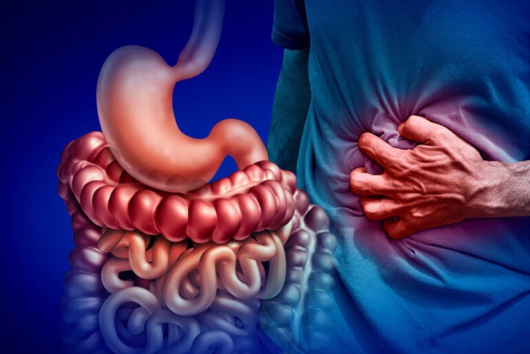 Vitamin D May Help Restore Immune Tolerance in Inflammatory Bowel Disease