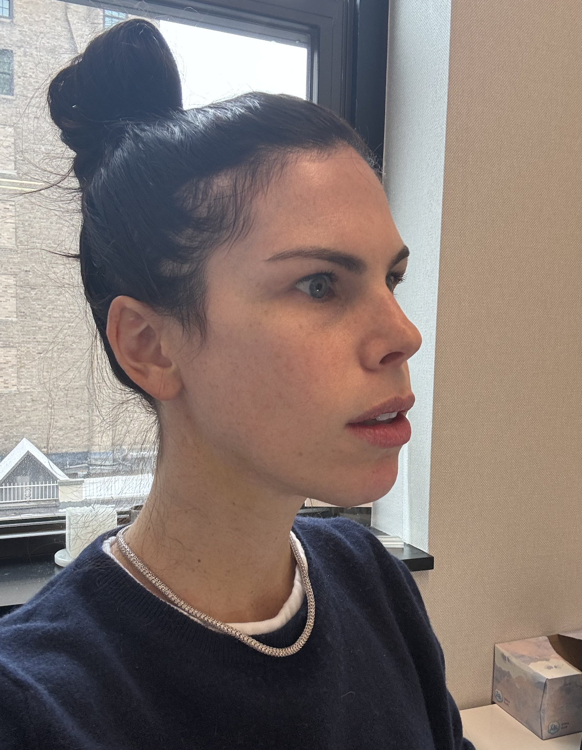 diana healing during the first week after facetite