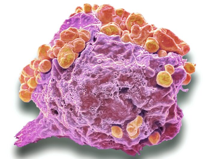 Lymphoma cancer cell, SEM