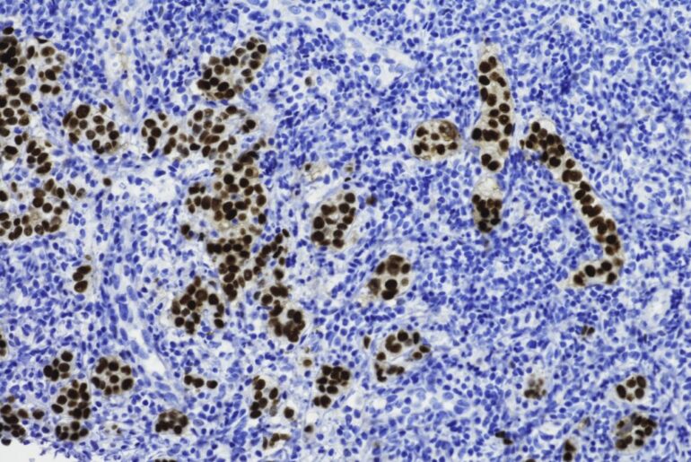 Immune Escape Mechanism in Metastatic Breast Cancer Identified