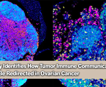 These microscopy images show tertiary lymphoid structures, immune cell hubs associated with improved patient survival and stronger responses to immunotherapy. Inhibiting FAK encourages the formation of these hubs. Red represents B cells, yellow represents T cells, and all cells are marked in blue. Photo Credit: UC San Diego Health Sciences via Newswise