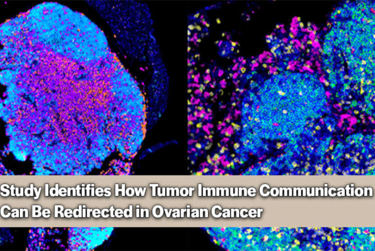 These microscopy images show tertiary lymphoid structures, immune cell hubs associated with improved patient survival and stronger responses to immunotherapy. Inhibiting FAK encourages the formation of these hubs. Red represents B cells, yellow represents T cells, and all cells are marked in blue. Photo Credit: UC San Diego Health Sciences via Newswise