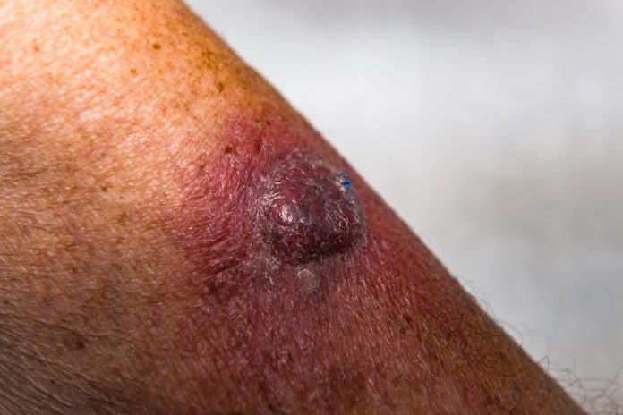 Invasive Squamous Cell Carcinoma, skin cancer, on Left Arm