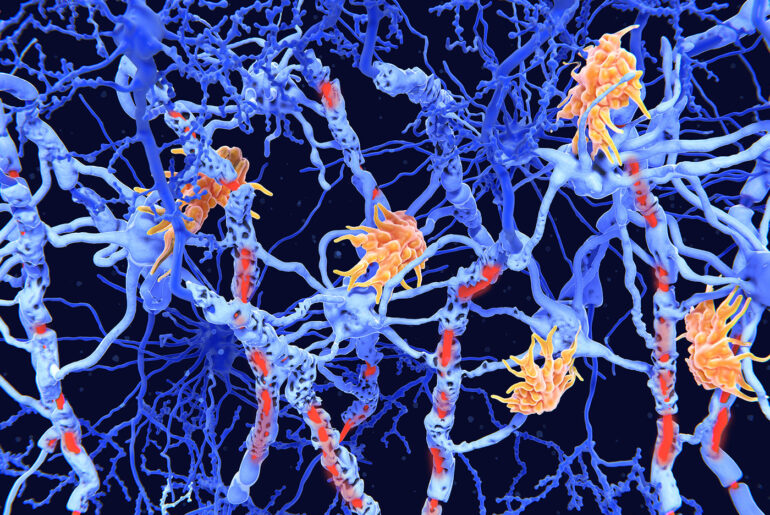 Gut-Immune Link Identified in Multiple Sclerosis-Related Neuroinflammation