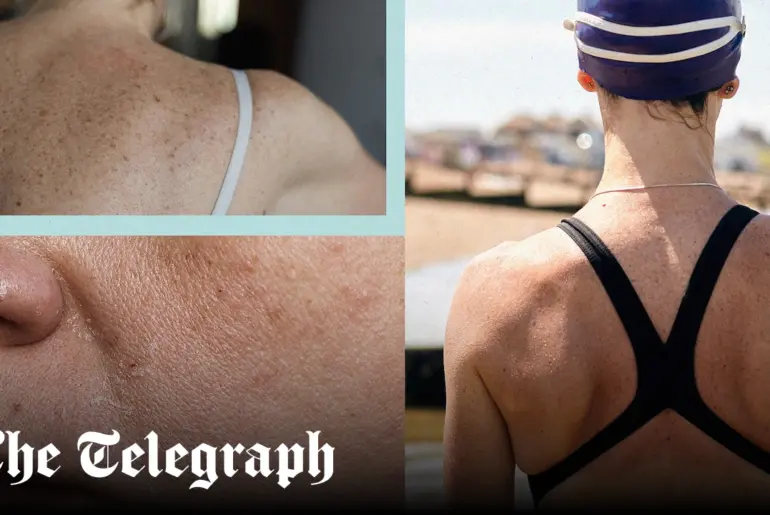 From runner’s face to swimmer’s sunburn: How exercise affects your skin