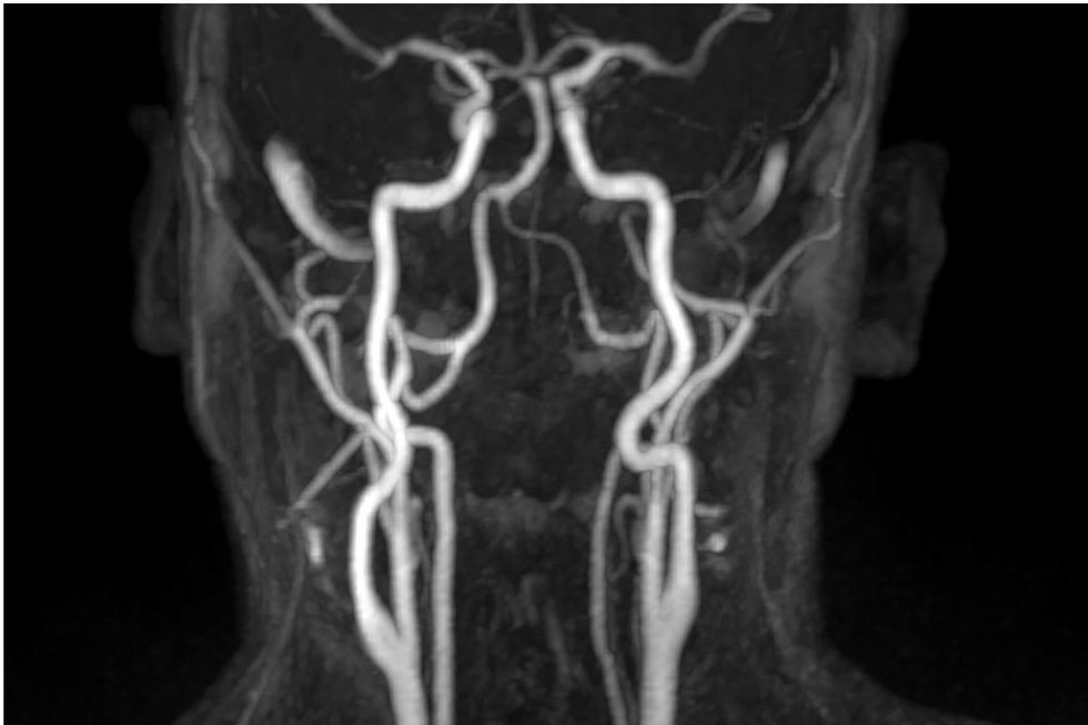 ARTERIES LEADING TO BRAIN