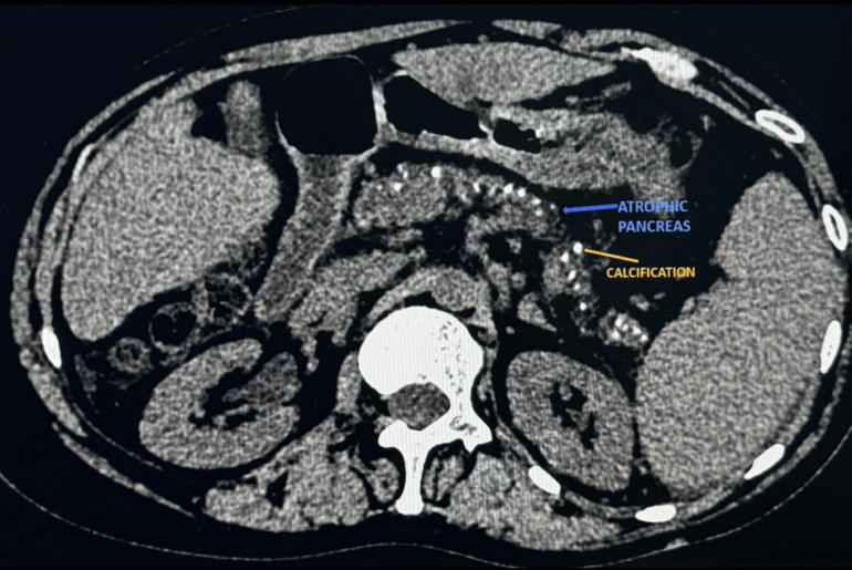 Clinically Symptomatic Vitamin E-Associated Peripheral Neuropathy: An Overlooked Reversible Neurological Sequela of Exocrine Insufficiency of Chronic Pancreatitis With Type 3c Diabetes