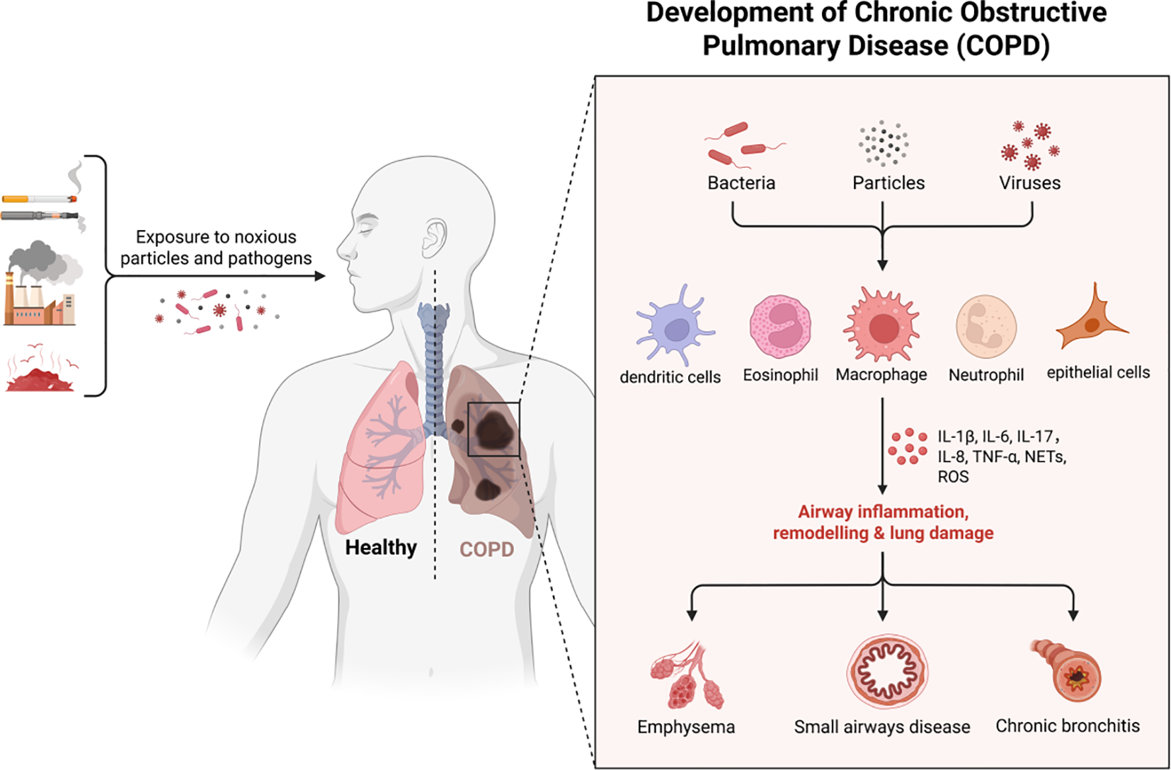 Diagram illustrating the development of Chronic Obstructive Pulmonary Disease (COPD). It shows exposure to smoke, pollution, and pathogens leading to lung damage. The body's response involves cells like dendritic cells, eosinophils, macrophages, neutrophils, and epithelial cells, contributing to airway inflammation and remodeling. This results in COPD conditions such as emphysema, small airways disease, and chronic bronchitis. The image also compares healthy lungs with those affected by COPD.