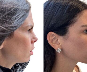 before and after facetite, a woman's chin and jaw profile