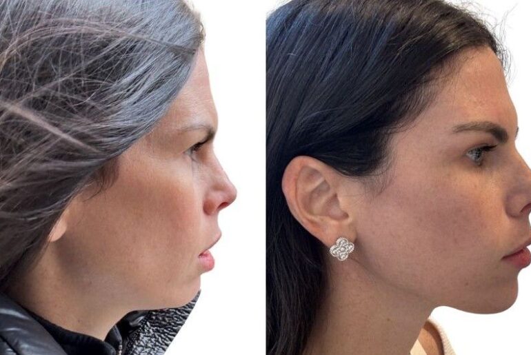 before and after facetite, a woman's chin and jaw profile