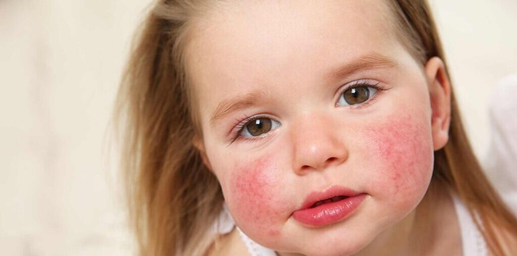 Why eczema often begins in infancy