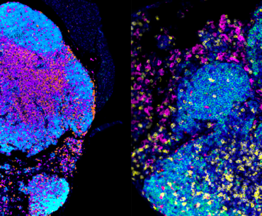 Rewiring Immune System Offers New Path to Better Ovarian Cancer Treatment