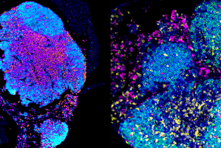Rewiring Immune System Offers New Path to Better Ovarian Cancer Treatment