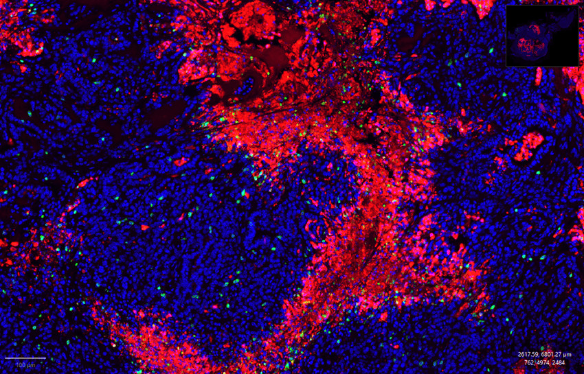 Immunofluorescent image of a mouse pancreas tumor. In the middle of the image is a roughly mirrored C-shape of red cells, indicating apoptosing tumor cells, surrounded by cells stained blue. Across the tissue, green cells represent infiltrating T cells.