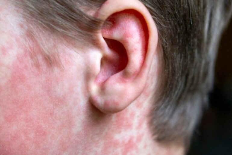 As spring break begins, health experts warn of 'immune amnesia' from measles