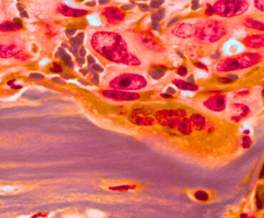 Blocking biotin could expose a weakness in cancer cells