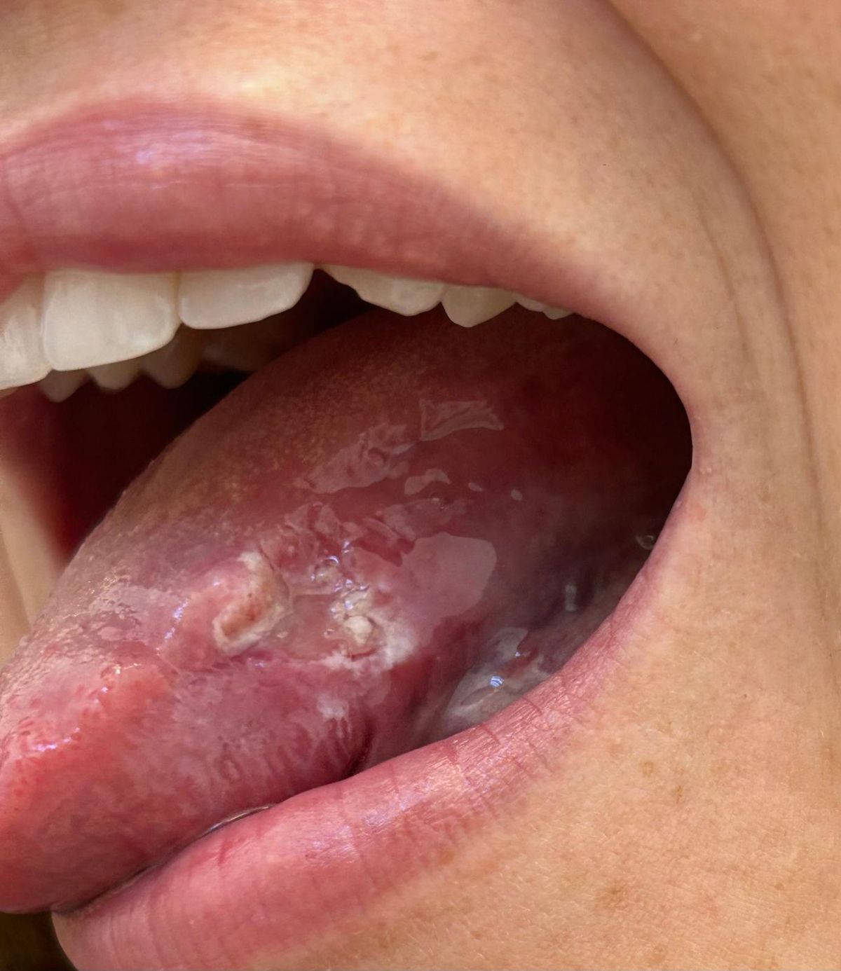 A picture of Olivia's tongue - which she is sharing to help others who fear they may have mouth cancer