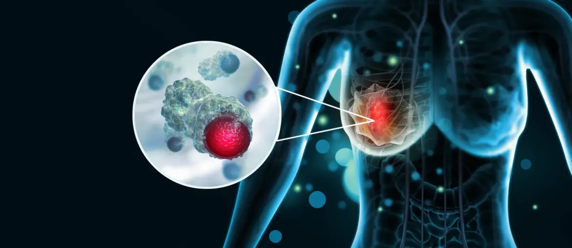How aggressive breast cancer turns off the immune system