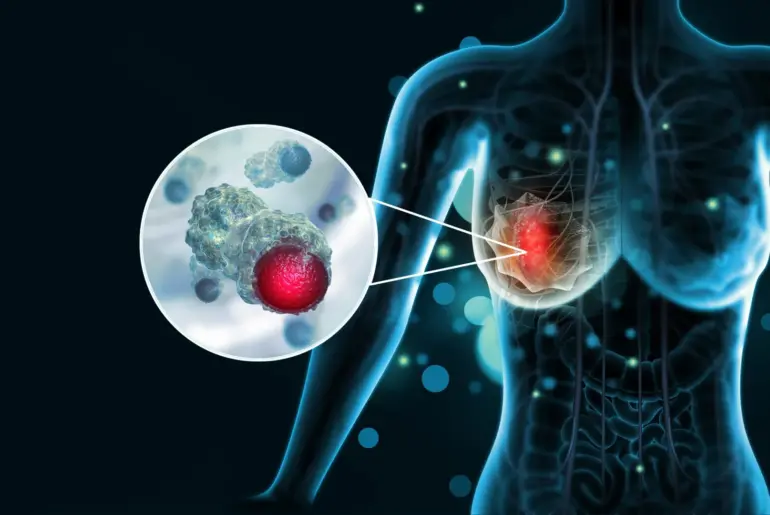 How aggressive breast cancer turns off the immune system