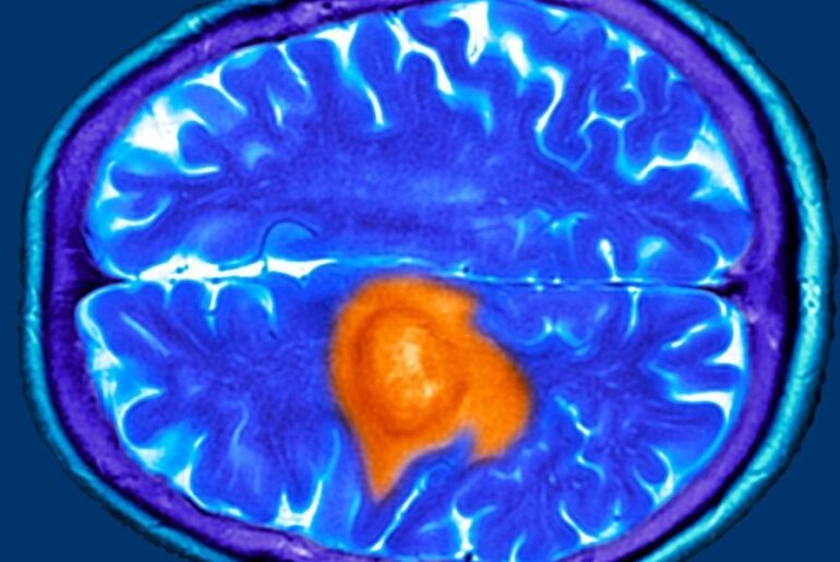 Dementia warning as midlife nutrient linked to hidden brain changes 16 years later