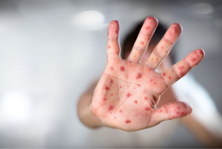 Cheltenham School District is one of many PA districts to fall below herd immunity threshold for measles, according to a Pittsburgh Post-Gazette investigation