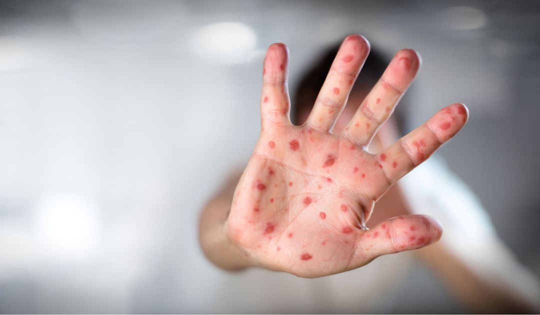 Cheltenham School District is one of many PA districts to fall below herd immunity threshold for measles, according to a Pittsburgh Post-Gazette investigation