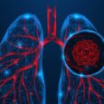 Immune mapping technique reveals lung cancer microenvironment at single-cell resolution