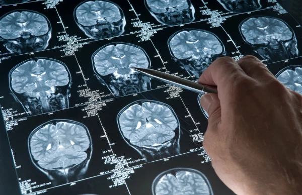 How Scientists Made the Immune System Destroy Brain Tumors