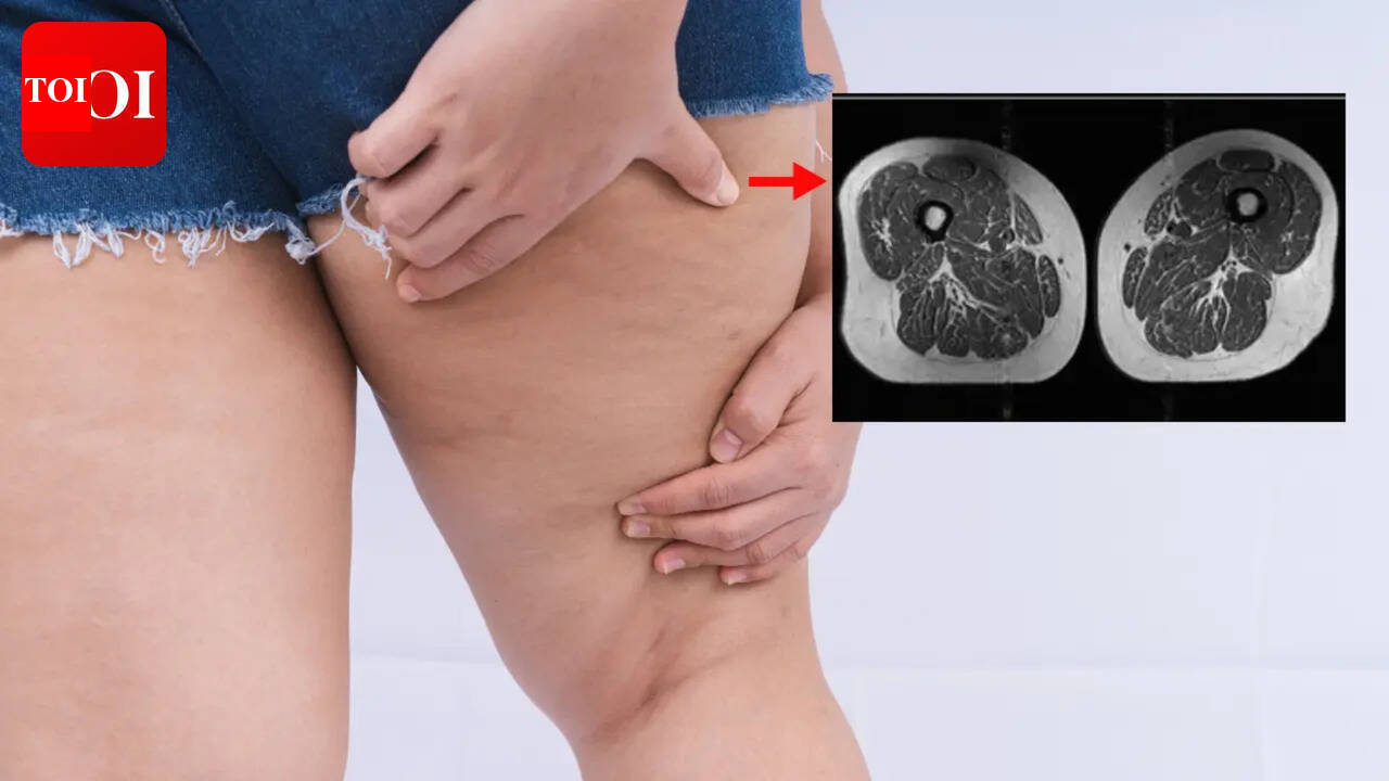 Ultra-Processed Foods: Ultra-processed foods linked to thigh fat accumulation and osteoarthritis