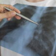 New lung cancer model reveals how tumor location shapes the immune response