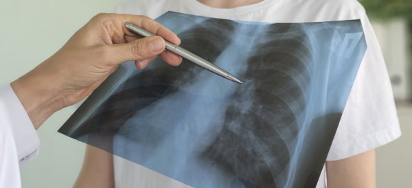 New lung cancer model reveals how tumor location shapes the immune response