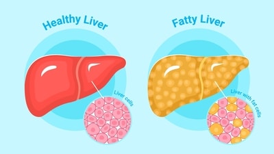 Fatty liver disease can progress to fibrosis and chronic liver failure if untreated. (Freepik)